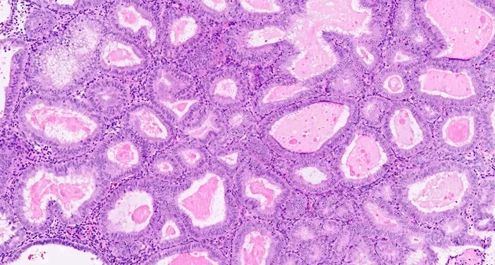 Does Endometrial Hyperplasia Cause Infertility?