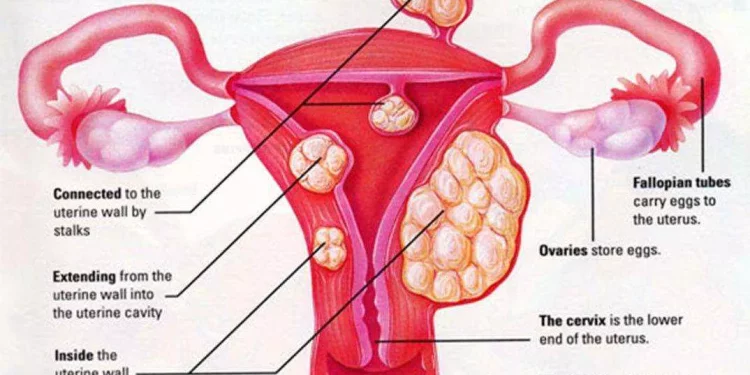 uterine fibroids